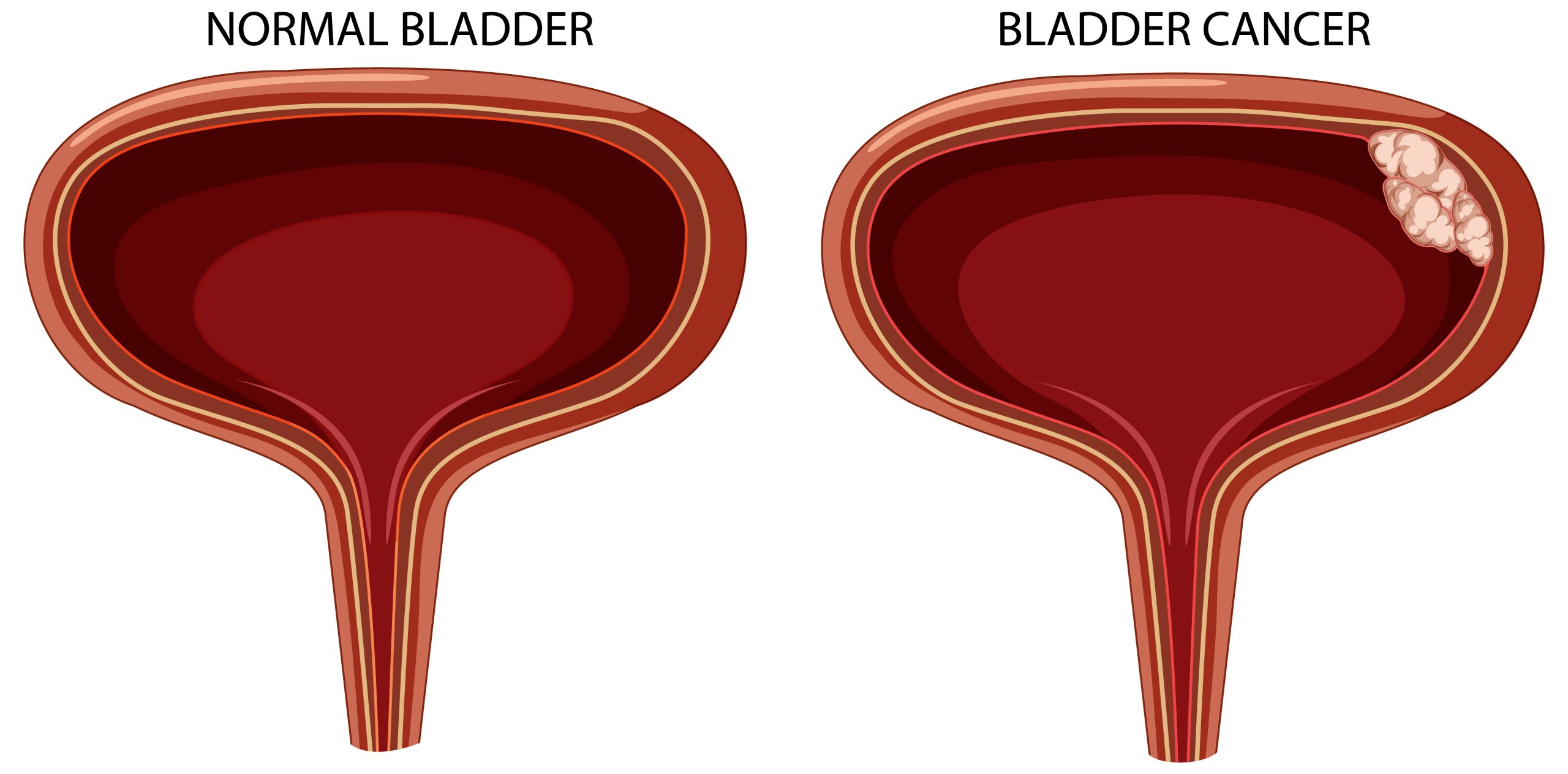 Bladder Cancer
