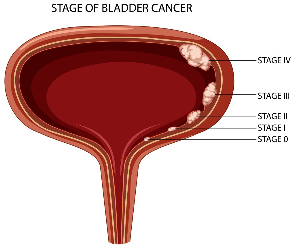 bladder cancer treatment in Mumbai