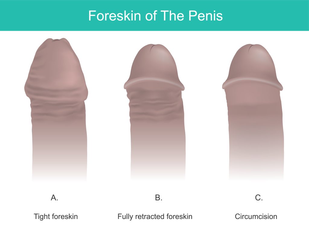 Para phimosis treatment in Mumbai - Stages of foreskin shown in graphic