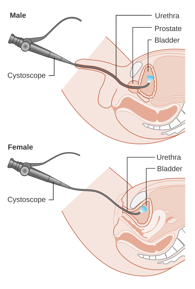 Cystolitholapaxy for Kidney Stone treatment in Mumbai