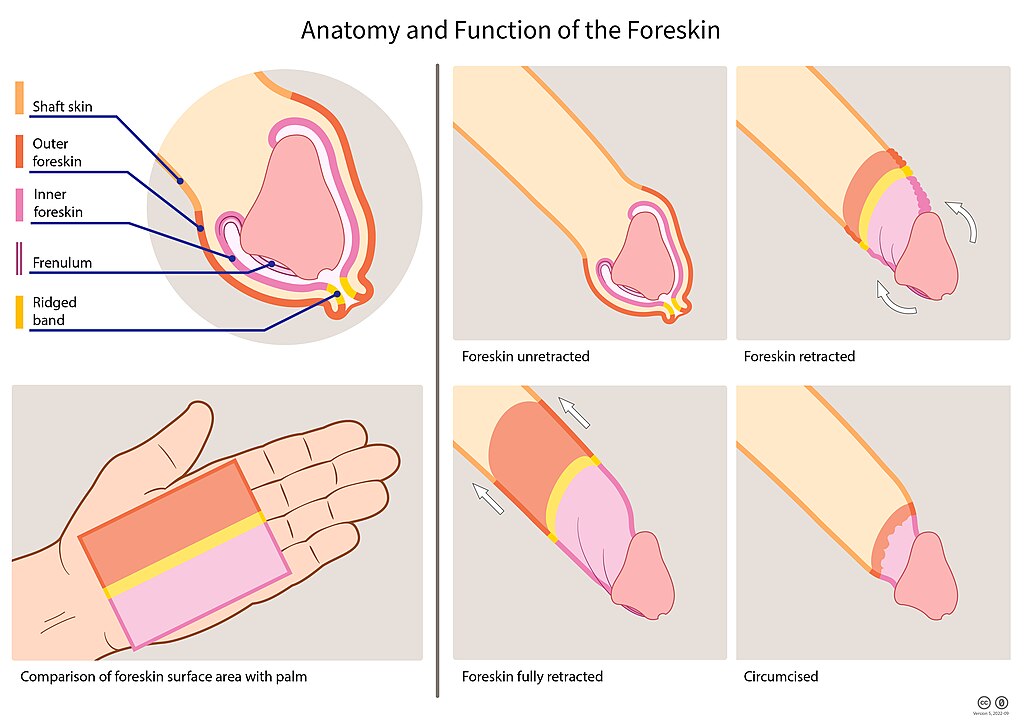 Balanitis treatment in Mumbai - Foreskin Infection on penis