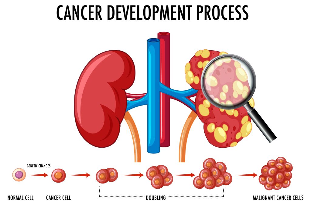Kidney cancer treatment in Mumbai - Kidney cancer development process explained in vector graphic