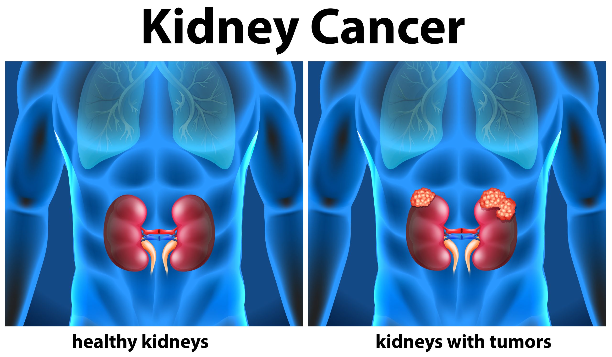 Renal Tumour Treatment in Mumbai
