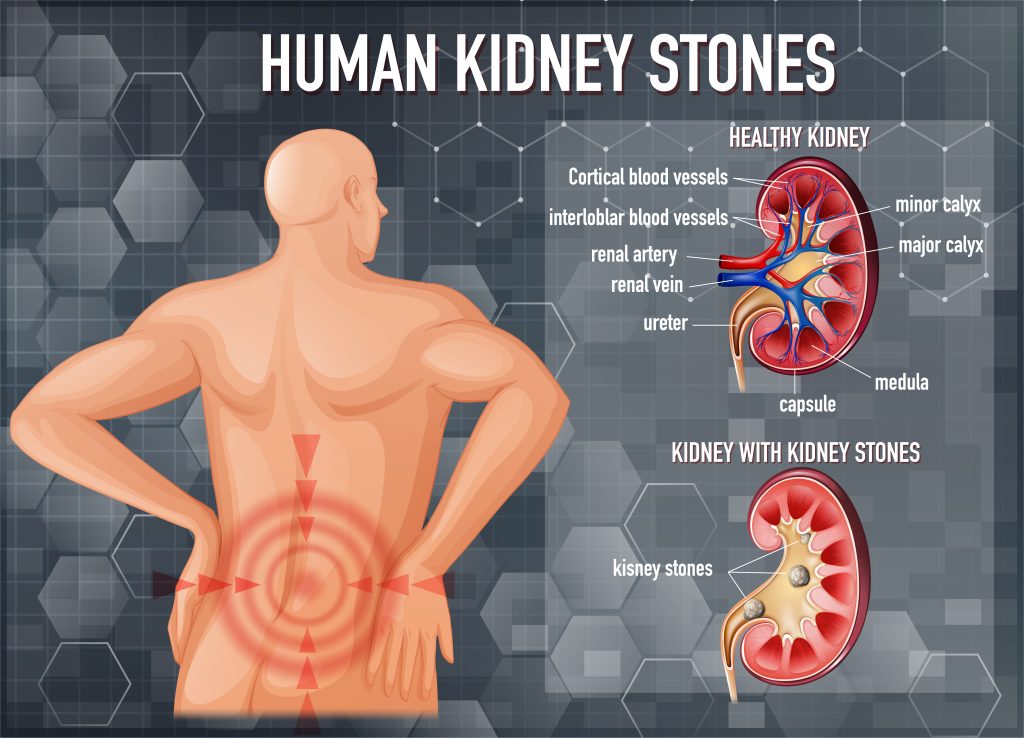 kidney stones treatment in Mumbai - a graphical representation of various kidney stones