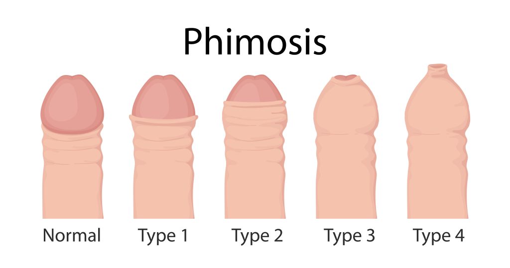 Phimosis Treatment in Mumbai