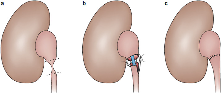 Ureteropelvic Junction Obstruction Treatment