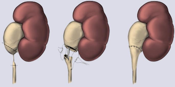 Ureteropelvic-Junction-Obstruction