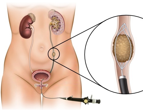Ureteroscopy in Mumbai for Kidney Stones