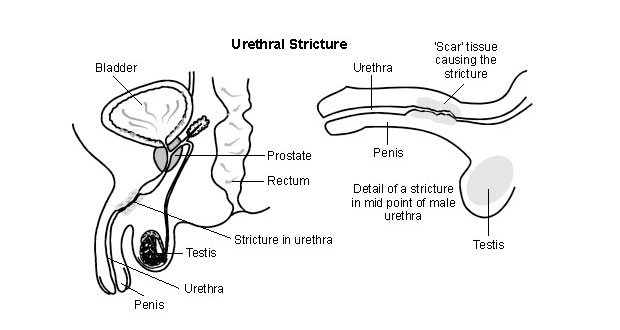 Stricture Urethra