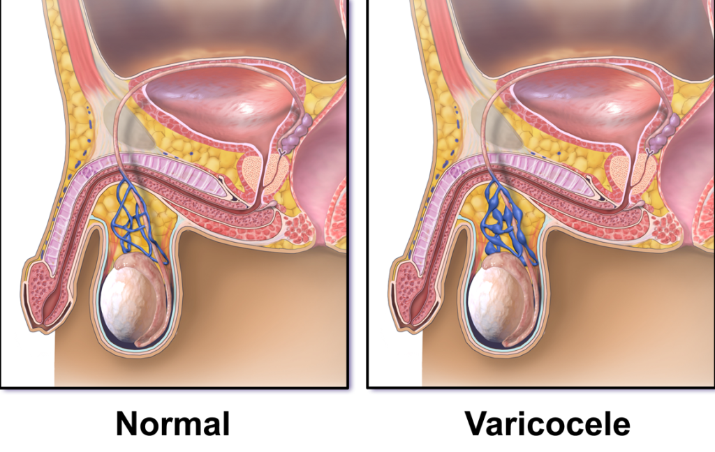 Varicocele Treatment in Mumbai