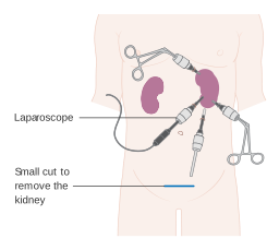 Kidney Transplant in Mumbai