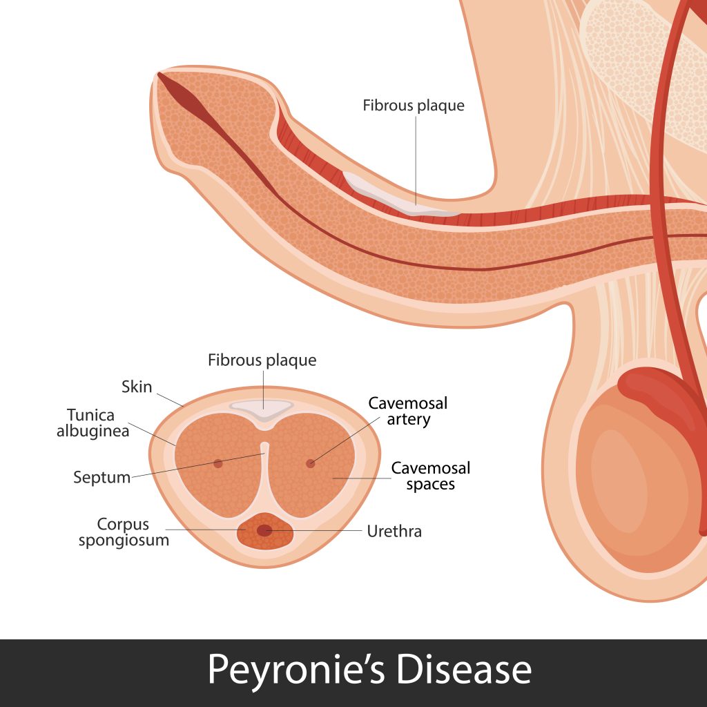 Peyronie Disease Treatment in Mumbai