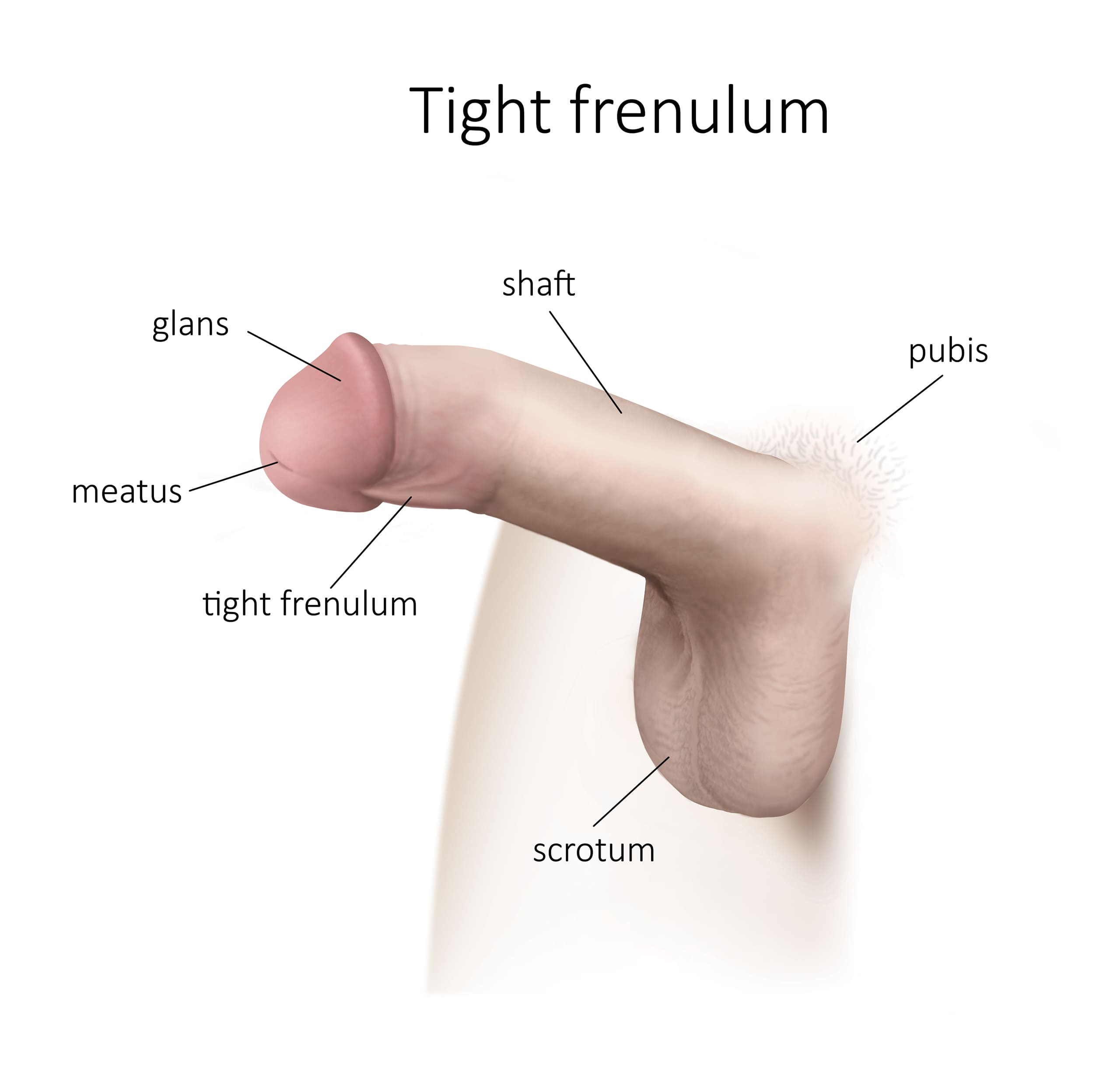 Short Frenulum Treatment in Mumbai