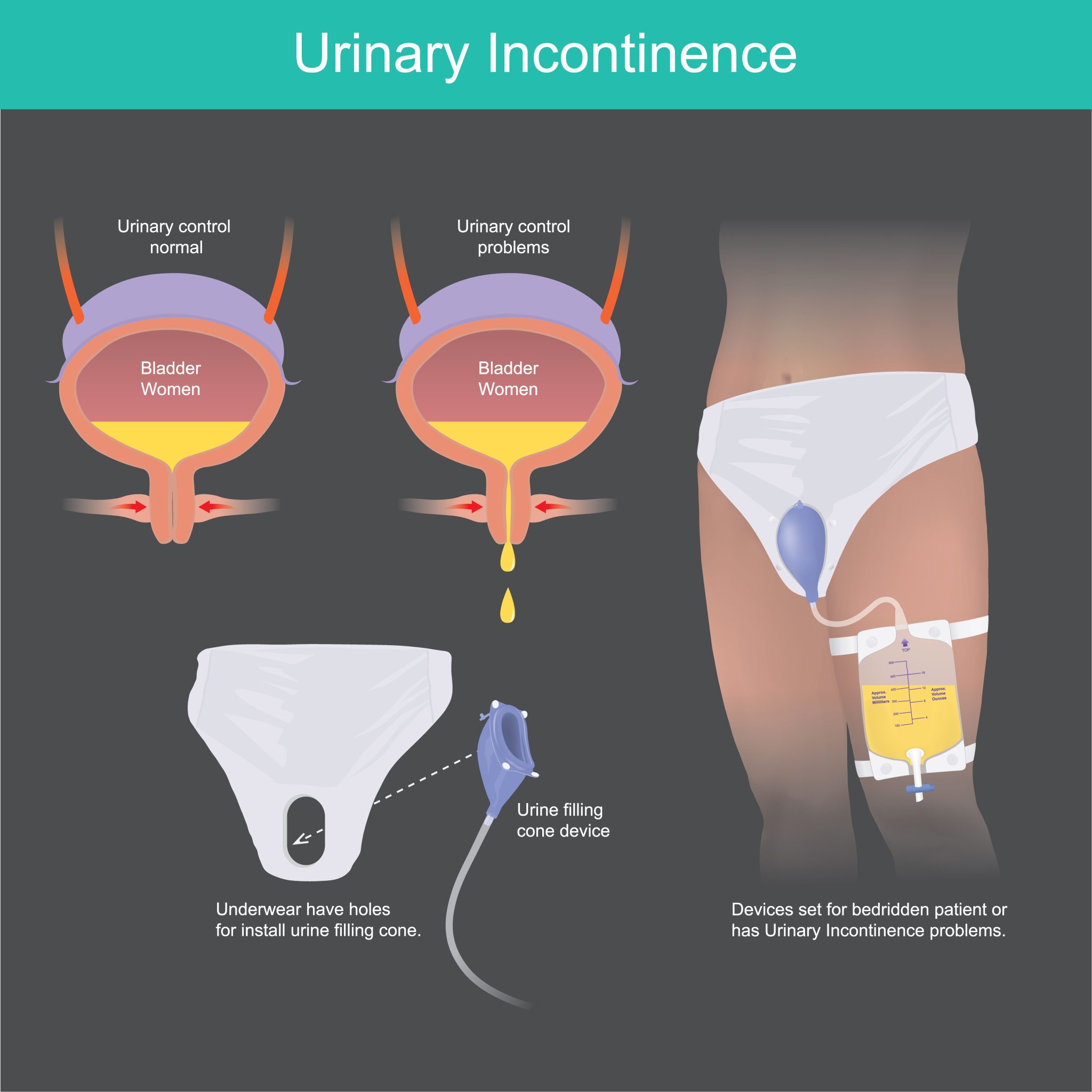 Stress Urinary Incontinence Treatment in Mumbai - Dr Amit Gala